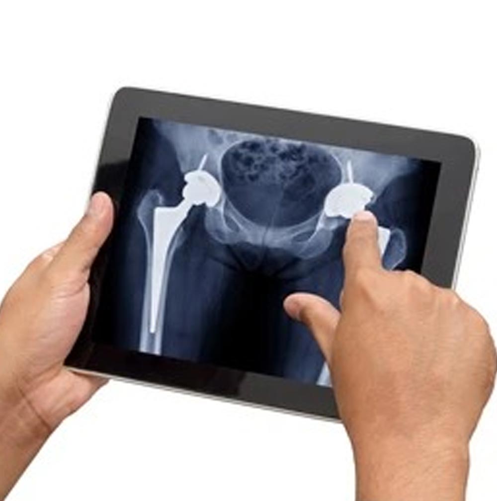 Risks and Complicationstotal- of hip-replacement